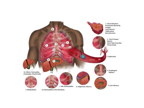 Causes of Emphysema